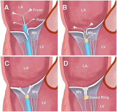Impact of Leaflet Tethering on Residual Regurgitation in Patients With Degenerative Mitral Disease After Interventional Edge-to-Edge Repair